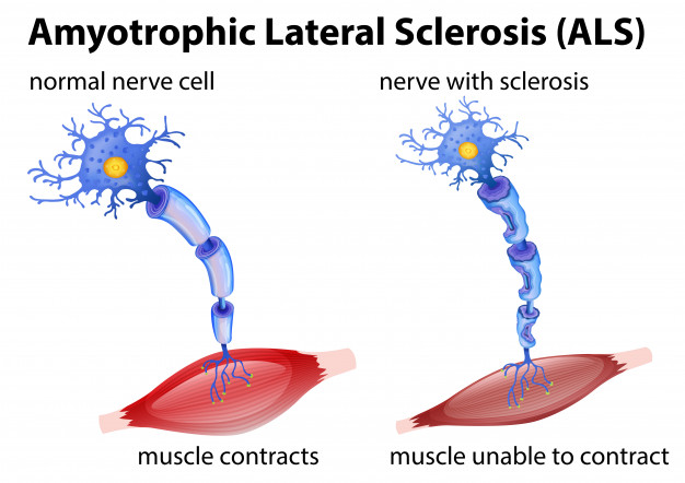 People with ALS - Poor sleep rapidly intensifies its progression
